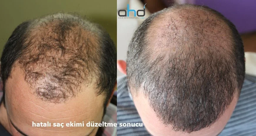 kötü saç ekimini düzeltme sonucu