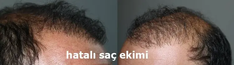 kötü bir saç ekiminde, dik çıkan saç yönleri