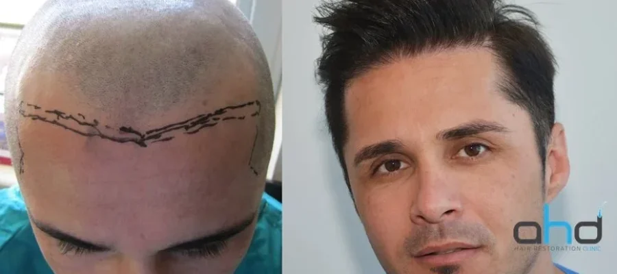 natural hair transplant