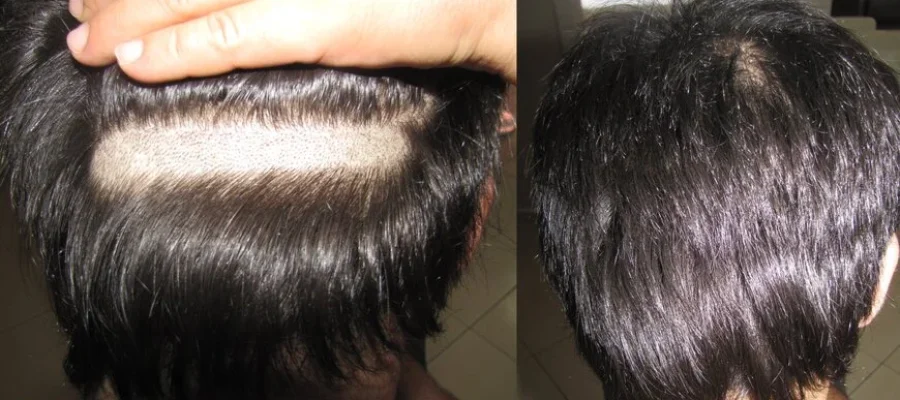 no shave hair transplant
