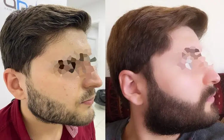Risultati del trapianto per l'ispessimento della barba