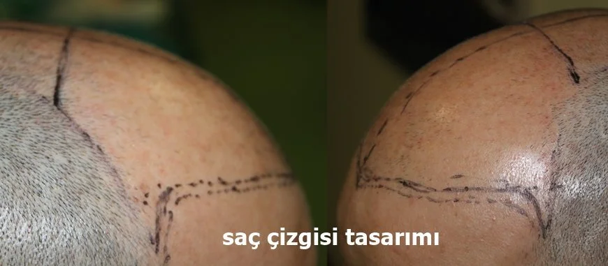 saç çizgisi oluşturma