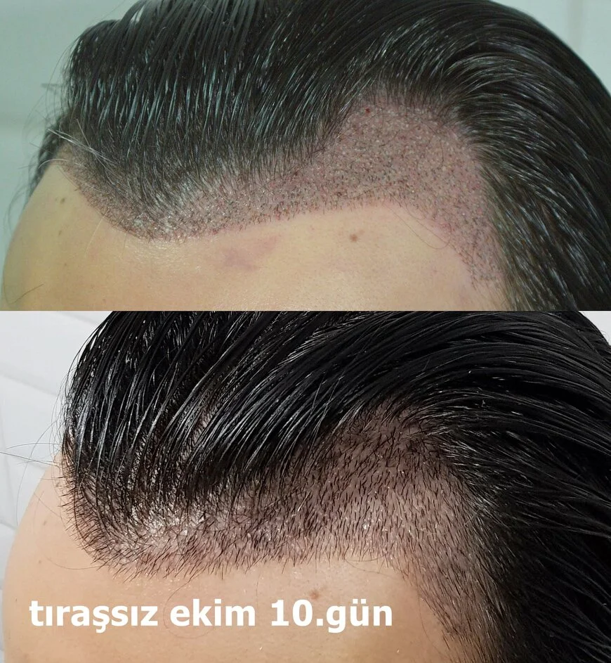 saç kesmeden saç ekimi