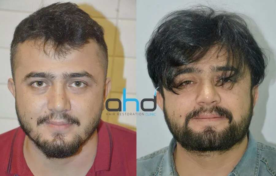 sakal bıyık  ve saç ekimi sonuç fotoğrafı