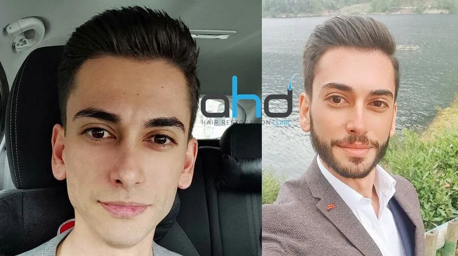 sakal ekiminden sonra tıraşlı görüntü