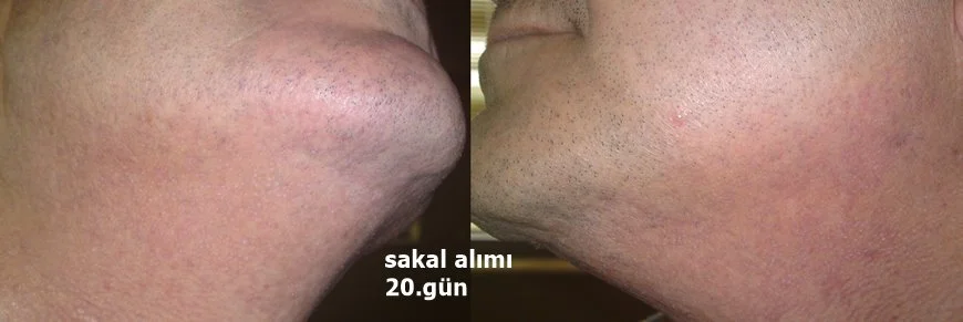 sakaldan saç ekimi sonrası