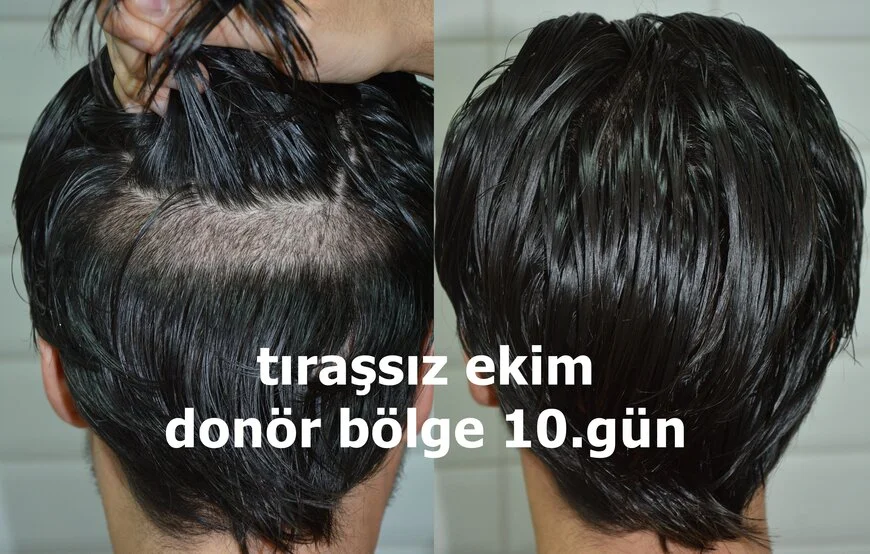 tıraşsız saç ekimine bir örnek