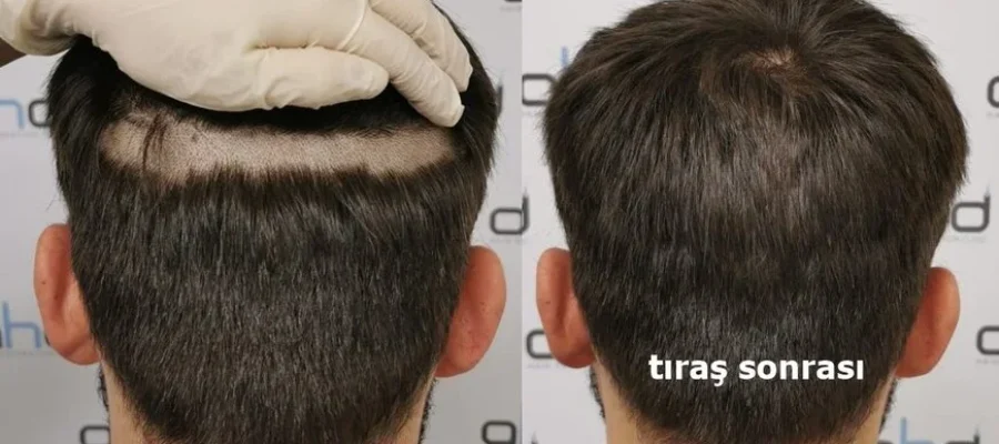 tıraşsız saç ekimi