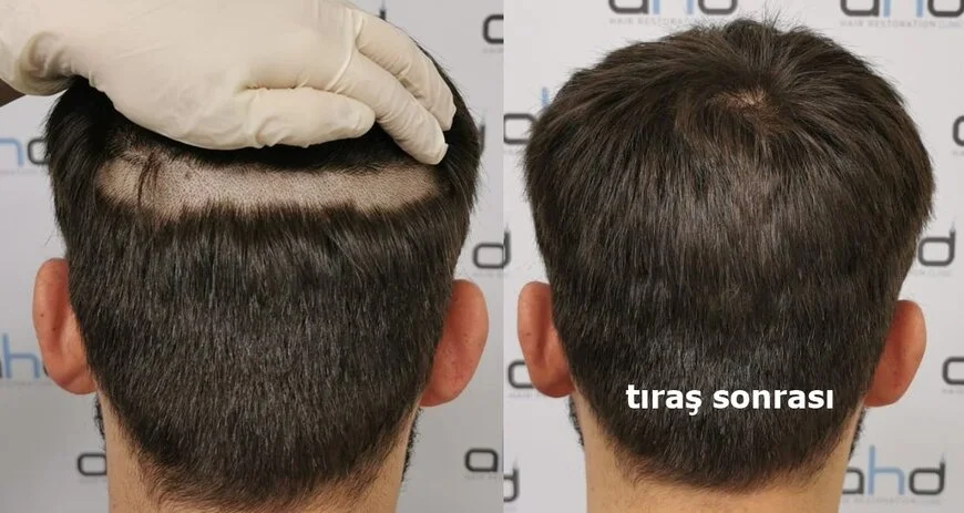 tıraşsız saç ekimi