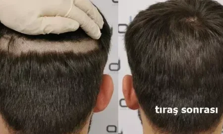 tirassiz_sac_ekimi