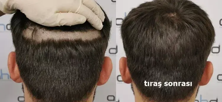 tirassiz_sac_ekimi