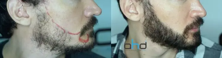 imagem antes e depois de transplante de barba