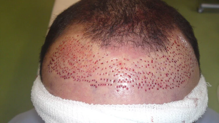Para corrigir o transplante capilar mal-sucedido, os enxertos de cabelo defeituosos foram removidos.