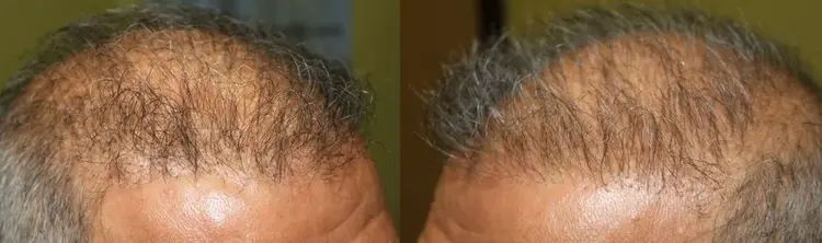 Um resultado ruim que ocorre após um transplante capilar.