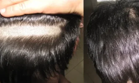 transplante capilar sem raspar o cabelo