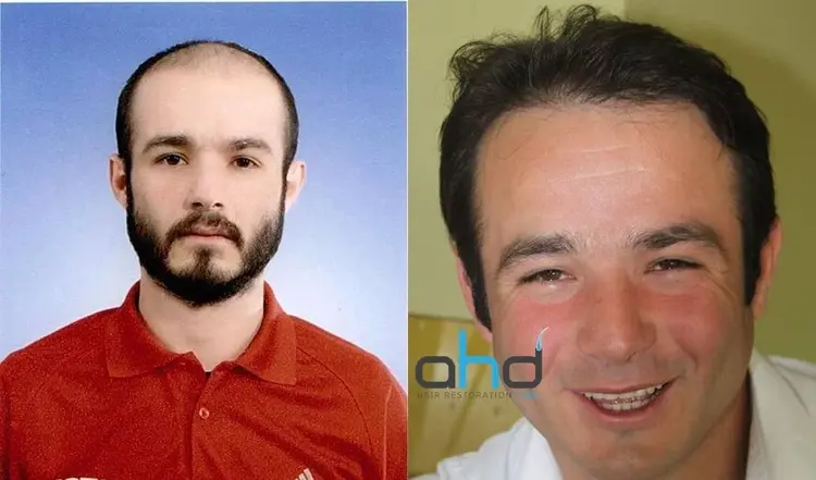 Una attaccatura dei capelli naturale e un risultato di trapianto di capelli perfetto.