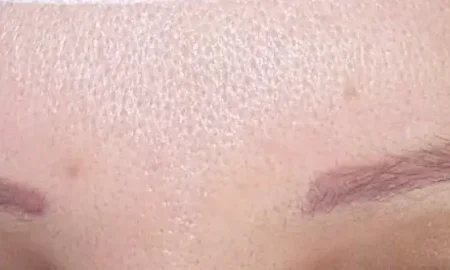 wenkbrauwtransplantatie