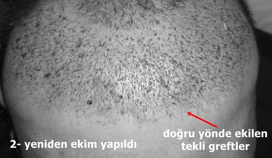 yanlış yapılan saç ekimini düzeltme