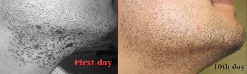 10 days after graft harvesting from the beard area. No scar is visible.