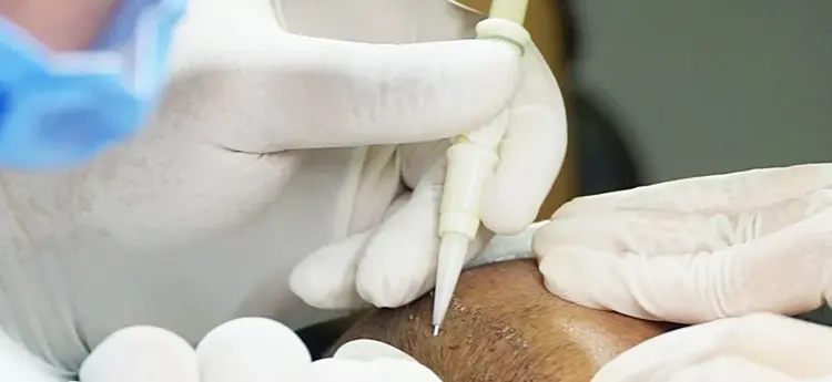 DHI-Haartransplantation