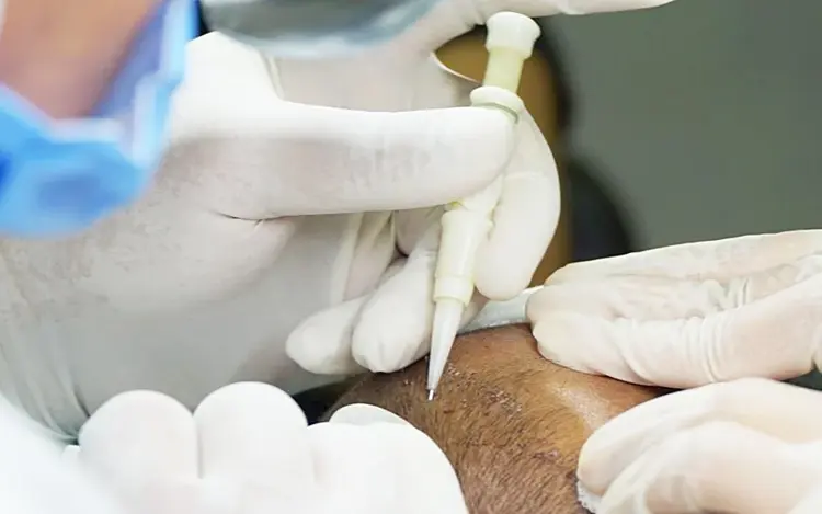 Die Anwendung der DHI-Technik erhöht die Erfolgsrate von Haartransplantationen.