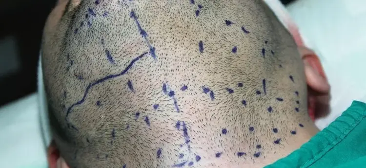 Haartransplantatie van Baard naar Hoofd