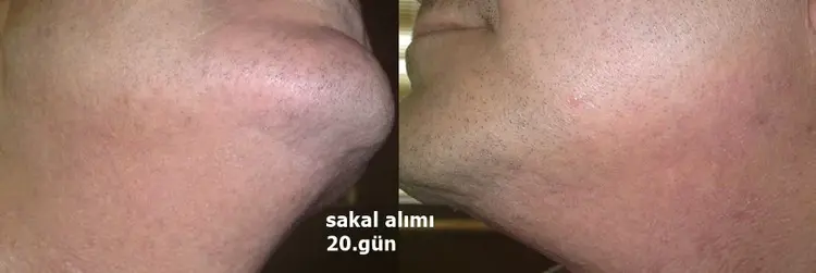 Baard naar hoofdhuid haartransplantatie en het donor gebied 20 dagen later"