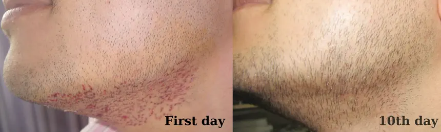 Beard hairs were taken from the donor area. Compare the appearance on day 1 and day 10.