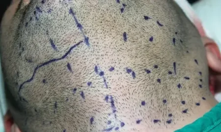 Trasplante de pelo de barba a cabeza