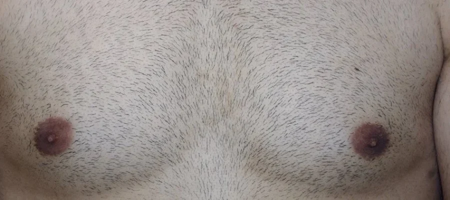body hair transplant to head