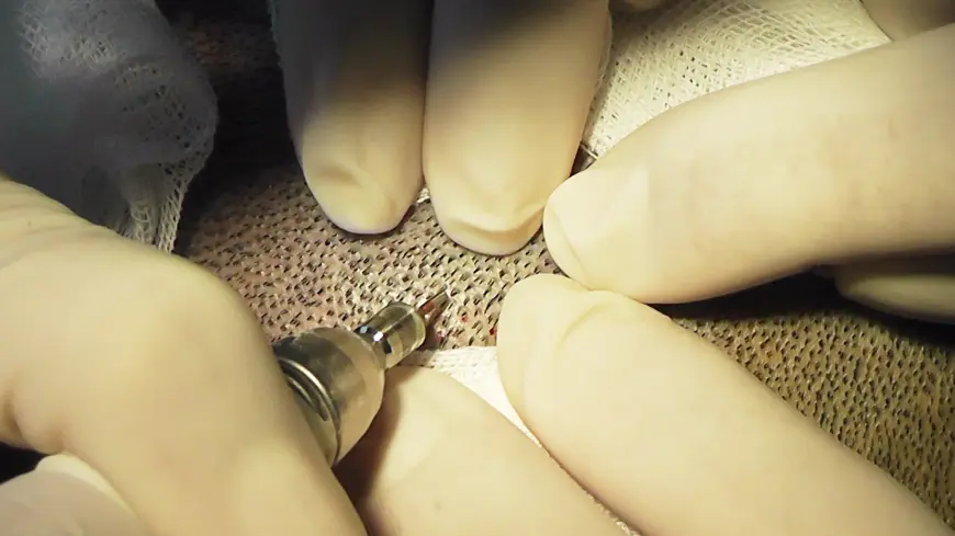 follicular unit extraction 