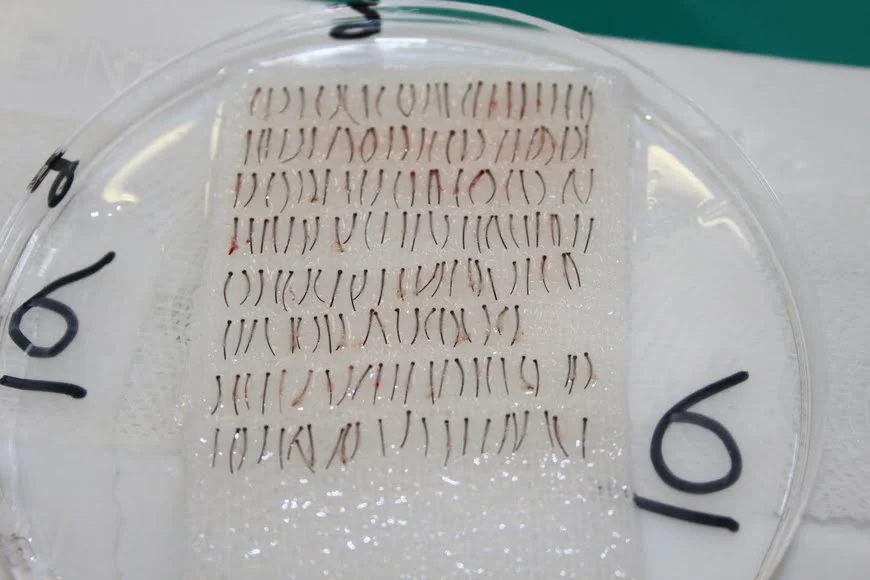 Beard grafts are utilized as an alternative donor source in hair transplant procedures