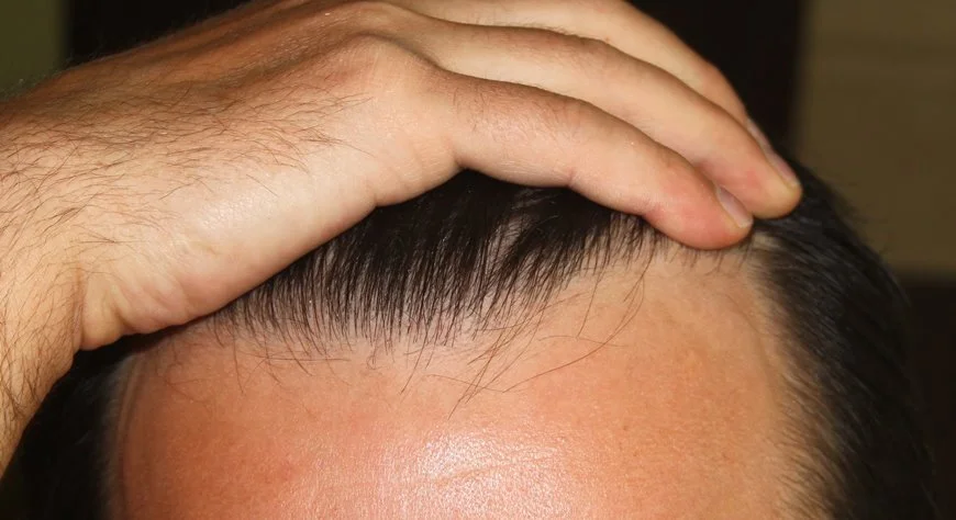 natural hair transplant result