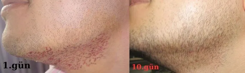 donör bölgeden sakal kılları alındı. 1 ve 10 gün görüntüsünü kıyaslayın.