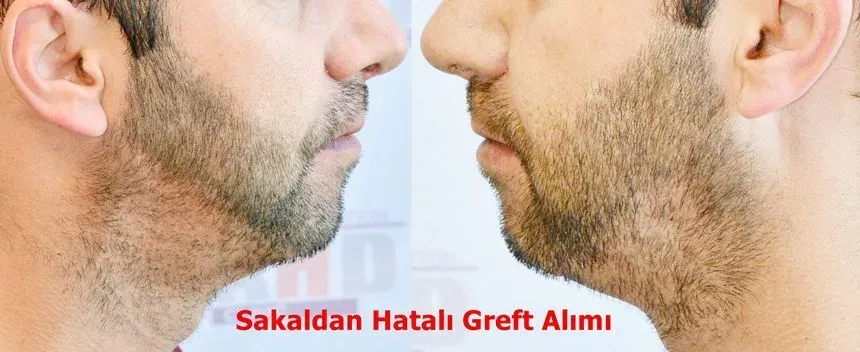 sakaldan hatalı greft alımıyla oluşan kötü görüntü