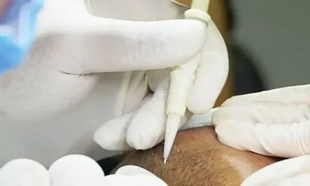 trapianto capelli dhi