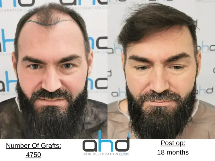 Eccellente risultato di un trapianto di capelli (prima e dopo) eseguito con il metodo DHI.