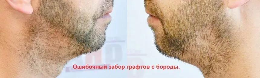 Неправильно были взяты графты из области бороды. Однако внешний вид получился очень плохим.