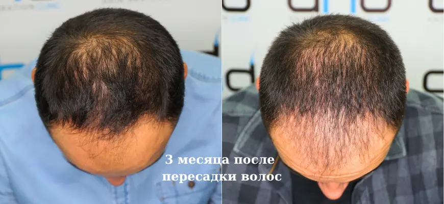 Фото через 3 месяца после пересадки волос