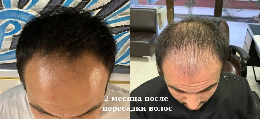 пересадка волос 2-й месяц