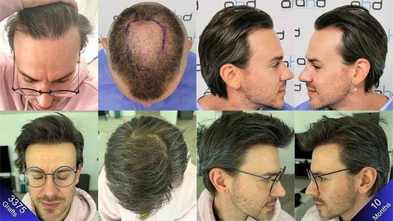 El increíble resultado conseguido después de 11 meses con un trasplante de cabello de 3200 injertos.