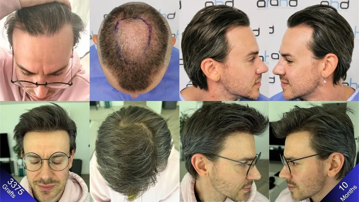 The dense and natural-looking hair transplant result achieved with 3375 grafts.