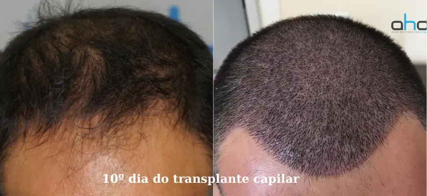 Como fica após 10 dias do implante capilar