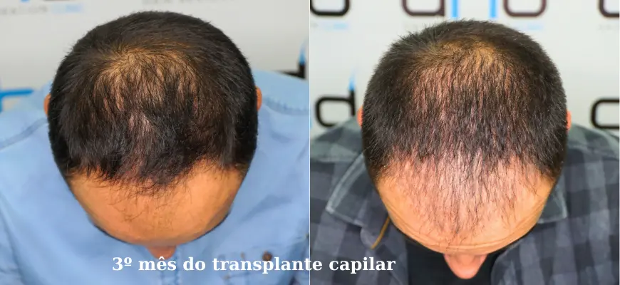 Foto de 2 meses após o transplante capilar
