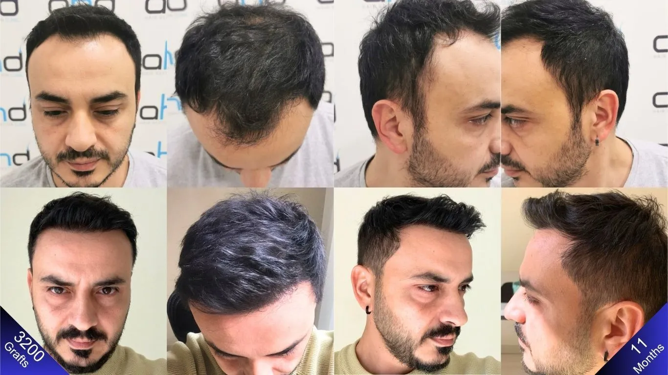 The incredible outcome achieved after 11 months with a 3200-graft hair transplant.