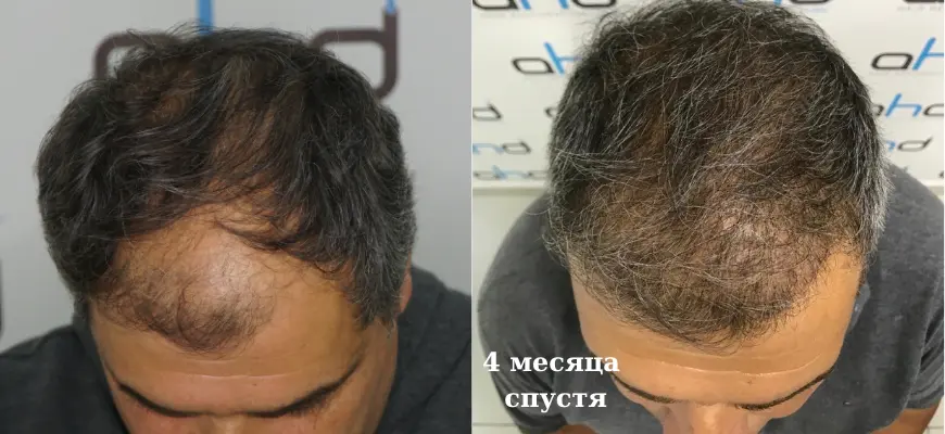 4 месяца после пересадки волос
