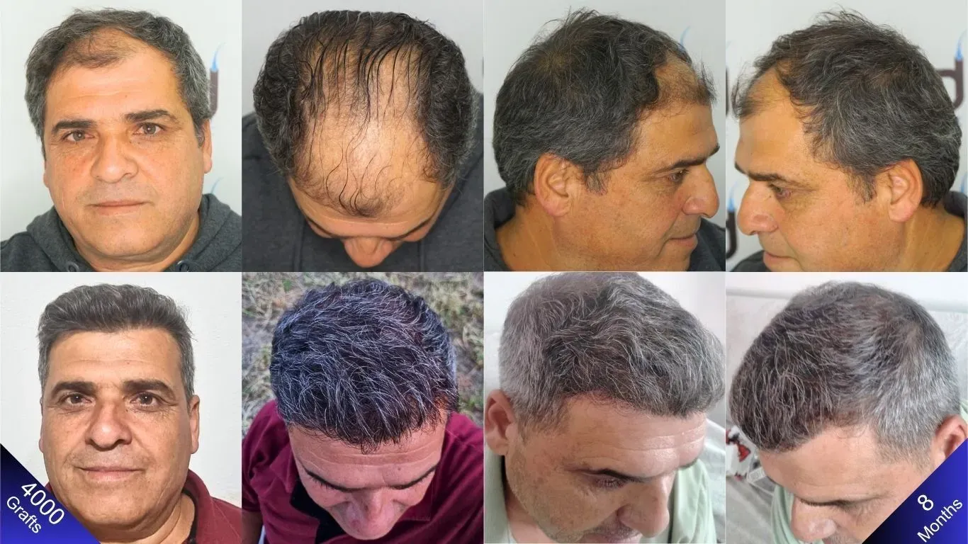Um homem que fez um transplante capilar de 4000 enxertos, mostrado de frente, de cima, pela direita e pela esquerda, com incríveis resultados de antes e depois.