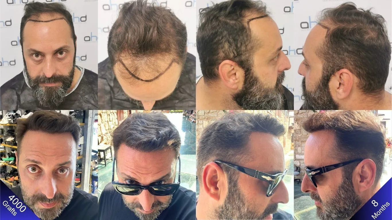 The amazing results from a 4000-graft hair transplant.