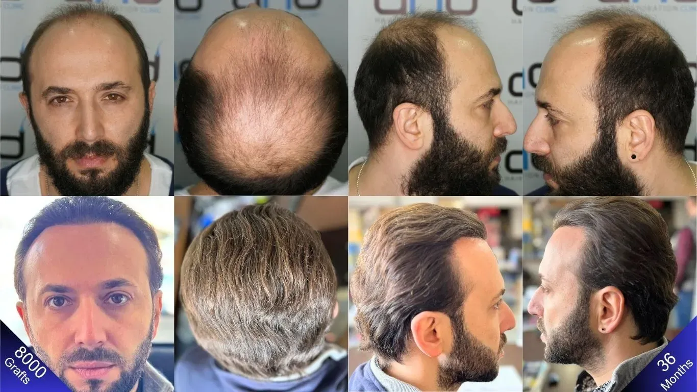 Um resultado feliz alcançado com um transplante capilar de 8000 enxertos. (Compare as visões da direita, esquerda, topo e frente).