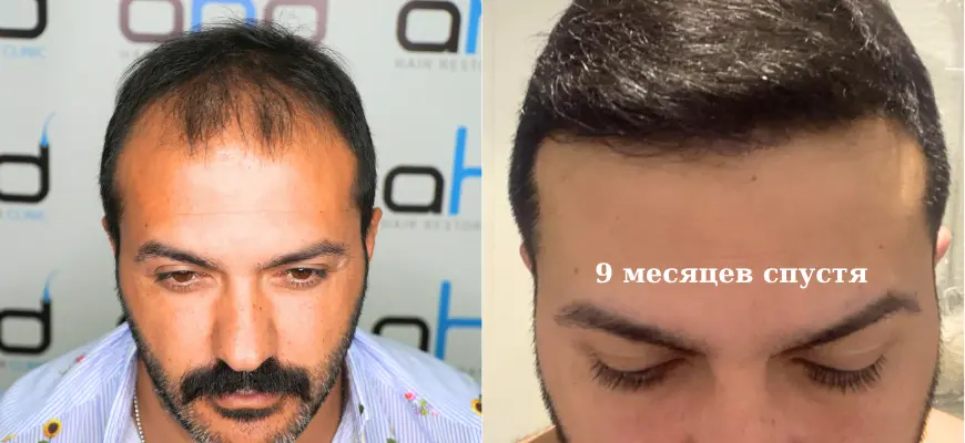 9 месяцев после пересадки волос